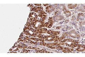 ABIN6272302 at 1/100 staining Human liver cancer tissue by IHC-P. (GALR3 antibody  (C-Term))