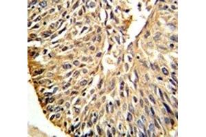 DHFR antibody IHC analysis in formalin fixed and paraffin embedded human lung carcinoma. (Dihydrofolate Reductase antibody  (AA 135-164))
