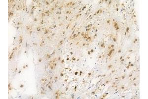 ABIN6261409 and ABIN6269309 at 1/100 staining human breast carcinoma by IHC-P.