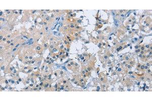 Immunohistochemistry of paraffin-embedded Human thyroid cancer tissue using BTN2A2 Polyclonal Antibody at dilution 1:50 (BTN2A2 antibody)