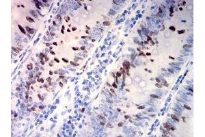 Immunohistochemical analysis of paraffin-embedded rectum cancer tissues using TOP2A mouse mAb with DAB staining. (Topoisomerase II alpha antibody  (AA 1100-1530))