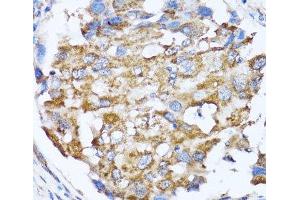 Immunohistochemistry of paraffin-embedded Human breast cancer using NDE1 Polyclonal Antibody at dilution of 1:100 (40x lens).