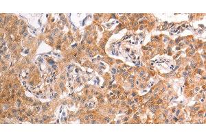 Immunohistochemistry of paraffin-embedded Human liver cancer tissue using TRPV4 Polyclonal Antibody at dilution 1:40 (TRPV4 antibody)