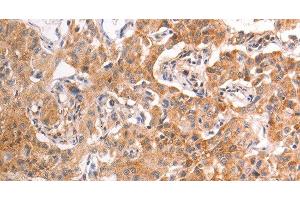 Immunohistochemistry of paraffin-embedded Human liver cancer tissue using TRPV4 Polyclonal Antibody at dilution 1:40 (TRPV4 antibody)