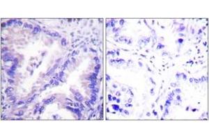 Immunohistochemistry analysis of paraffin-embedded human lung carcinoma tissue, using PP2A-alpha (Ab-307) Antibody. (PPP2CA antibody  (AA 260-309))