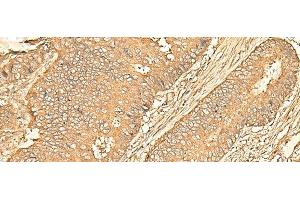 Immunohistochemistry of paraffin-embedded Human colorectal cancer tissue using RPS28 Polyclonal Antibody at dilution of 1:30(x200) (RPS28 antibody)