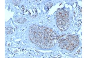 Formalin-fixed, paraffin-embedded human breast carcinoma stained with MDM2 Mouse Monoclonal Antibody (SMP14). (MDM2 antibody  (AA 154-167))
