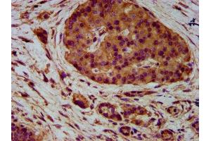 IHC image of ABIN7161114 diluted at 1:400 and staining in paraffin-embedded human pancreatic cancer performed on a Leica BondTM system. (PVRL4 antibody  (AA 91-199))