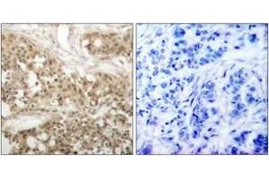 Immunohistochemistry analysis of paraffin-embedded human breast carcinoma, using PKC thet (Phospho-Ser676) Antibody.