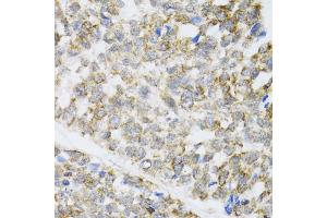 Immunohistochemistry of paraffin-embedded human esophageal cancer using ZAK antibody. (ZAK antibody)