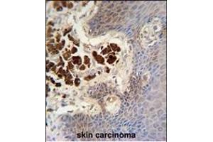 COL19A1 antibody (N-term) (ABIN654432 and ABIN2844168) immunohistochemistry analysis in formalin fixed and paraffin embedded human skin carcinoma followed by peroxidase conjugation of the secondary antibody and DAB staining.