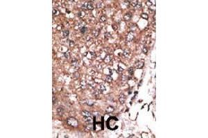Formalin-fixed and paraffin-embedded human hepatocellular carcinoma tissue reacted with HAND2 polyclonal antibody  , which was peroxidase-conjugated to the secondary antibody, followed by AEC staining.