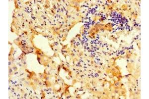 Immunohistochemistry of paraffin-embedded human lung cancer using ABIN7168333 at dilution of 1:100 (RBM12 antibody  (AA 1-200))