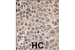 Formalin-fixed and paraffin-embedded human hepatocarcinoma tissue reacted with MTMR9 antibody , which was peroxidase-conjugated to the secondary antibody, followed by DAB staining.