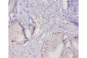 Immunohistochemistry of paraffin-embedded human prostate tissue using ABIN7160281 at dilution of 1:20 (MUC16 antibody  (AA 14067-14328))