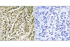 Immunohistochemistry analysis of paraffin-embedded human breast carcinoma tissue, using FEN1 Antibody. (FEN1 antibody  (AA 86-135))