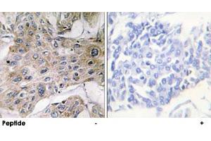 Immunohistochemistry analysis of paraffin-embedded human breast carcinoma tissue using COX7A2P2 polyclonal antibody . (COX7A2P2 antibody)
