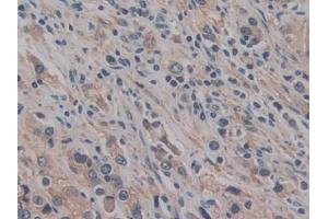 Detection of CD147 in Human Prostate cancer Tissue using Polyclonal Antibody to Cluster Of Differentiation 147 (CD147)