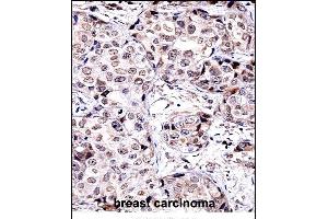 SIRT6 Antibody (C-term) ((ABIN657945 and ABIN2846889))immunohistochemistry analysis in formalin fixed and paraffin embedded human breast carcinoma followed by peroxidase conjugation of the secondary antibody and DAB staining.
