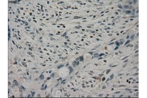 Immunohistochemical staining of paraffin-embedded Adenocarcinoma of colon tissue using anti-CRYABmouse monoclonal antibody. (CRYAB antibody)