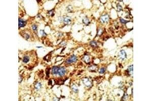 IHC analysis of FFPE human hepatocarcinoma stained with the Dnmt3a antibody (DNMT3A antibody  (AA 457-486))