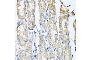 Immunohistochemistry of paraffin-embedded human gastric cancer using CCL3 antibody at dilution of 1:100 (40x lens). (CCL3 antibody)