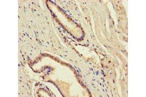 Immunohistochemistry of paraffin-embedded human prostate cancer using ABIN7144980 at dilution of 1:100 (DDX19A antibody  (AA 1-478))
