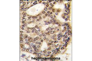 Formalin-fixed and paraffin-embedded human hepatocellular carcinoma reacted with HDGF polyclonal antibody  , which was peroxidase-conjugated to the secondary antibody, followed by DAB staining . (HDGF antibody  (C-Term))