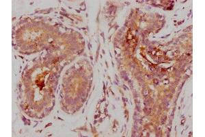 IHC image of ABIN7127625 diluted at 1:235 and staining in paraffin-embedded human breast cancer performed on a Leica BondTM system. (Recombinant MMP 9 antibody)