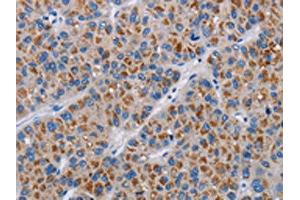 The image on the left is immunohistochemistry of paraffin-embedded Human liver cancer tissue using ABIN7190333(COX18 Antibody) at dilution 1/20, on the right is treated with synthetic peptide. (COX18 antibody)