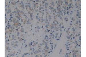 Detection of IkBb in Human Prostate Gland Cancer Tissue using Polyclonal Antibody to Inhibitory Subunit Of NF Kappa B Beta (IkBb) (Inhibitory Subunit of NF kappa B beta (AA 85-332) antibody)
