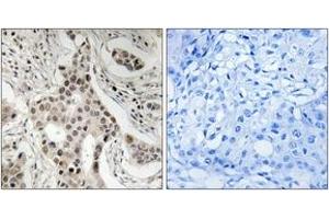 Immunohistochemistry analysis of paraffin-embedded human breast carcinoma, using NCoA2 (Phospho-Ser736) Antibody. (NCOA2 antibody  (pSer736))
