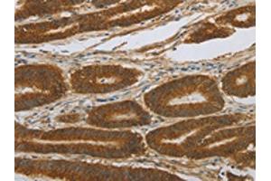 The image on the left is immunohistochemistry of paraffin-embedded Human colon cancer tissue using ABIN7191676(NOTCH4 Antibody) at dilution 1/30, on the right is treated with synthetic peptide. (NOTCH4 antibody)
