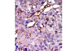 Formalin-fixed and paraffin-embedded human cancer tissue (breast carcinoma) reacted with the primary antibody, which was peroxidase-conjugated to the secondary antibody, followed by DAB staining. (CASK antibody  (C-Term))