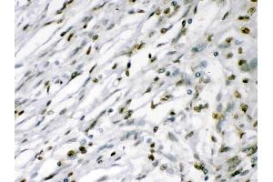 MEF2A was detected in paraffin-embedded sections of human meningeoma tissues using rabbit anti- MEF2A Antigen Affinity purified polyclonal antibody (Catalog # ) at 1 ? (MEF2A antibody  (C-Term))