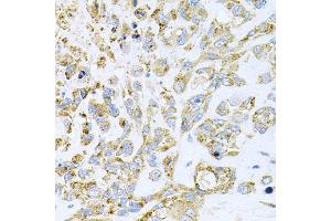 Immunohistochemistry of paraffin-embedded human lung cancer using HDAC3 antibody. (HDAC3 antibody)