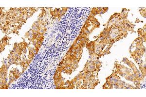 Detection of SPA2 in Human Lung cancer Tissue using Polyclonal Antibody to Surfactant Associated Protein A2 (SPA2) (SFTPA2 antibody  (AA 21-114))