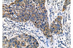 ABIN6262495 and ABIN6277945 at 1/100 staining Human esophageal cancer by IHC-P.