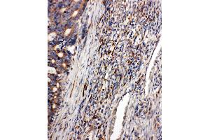Anti-CD163 antibody,  IHC(P) IHC(P): Human Intestinal Cancer Tissue (CD163 antibody  (C-Term))