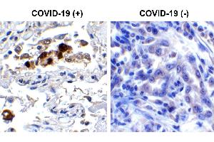Immunohistochemistry Validation of SARS-CoV-2 (COVID-19) Spike RBD in COVID-19 Patient Lung Immunohistochemical analysis of paraffin-embedded COVID-19 patient lung tissue using anti- SARS-CoV-2 (COVID-19) Spike RBD antibody (ABIN6952968, 0. (SARS-CoV-2 Spike antibody  (RBD))