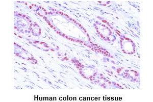 Paraffin embedded sections of human colon cancer tissue were incubated with anti-human MAT2A (1:50) for 2 hours at room temperature. (MAT2A antibody)