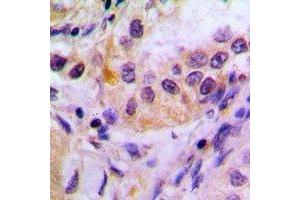 Immunohistochemical analysis of FKBP4 staining in human lung cancer formalin fixed paraffin embedded tissue section. (FKBP4 antibody)