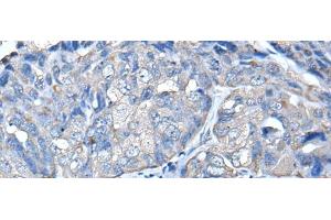 Immunohistochemistry of paraffin-embedded Human breast cancer tissue using PRKAR2A Polyclonal Antibody at dilution of 1:50(x200)