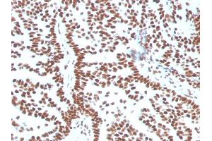 Formalin-fixed, paraffin-embedded human Breast Carcinoma stained with Estrogen Receptor alpha Mouse Monoclonal Antibody (ESR1/3556). (Estrogen Receptor alpha antibody  (AA 129-312))