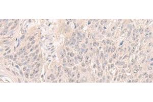 Immunohistochemistry of paraffin-embedded Human esophagus cancer tissue using HENMT1 Polyclonal Antibody at dilution of 1:30(x200) (HENMT1 antibody)