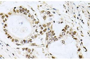 Immunohistochemistry of paraffin-embedded Human gastric cancer using MCL1 Polyclonal Antibody at dilution of 1:100 (40x lens). (MCL-1 antibody)