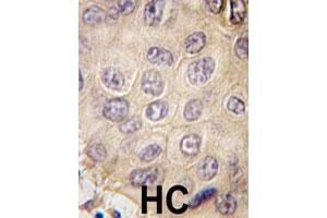 Formalin-fixed and paraffin-embedded human hepatocellular carcinoma reacted with EDA polyclonal antibody  , which was peroxidase-conjugated to the secondary antibody, followed by DAB staining. (Ectodysplasin A antibody  (N-Term))