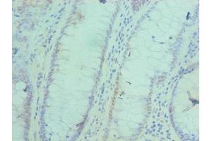 Immunohistochemistry of paraffin-embedded human colon cancer using ABIN7143052 at dilution of 1:100 (BAF53A antibody  (AA 1-280))
