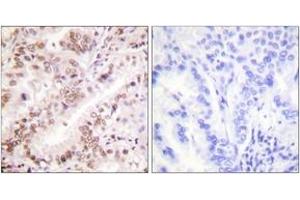 Immunohistochemistry analysis of paraffin-embedded human lung carcinoma, using Estrogen Receptor-alpha (Phospho-Tyr537) Antibody. (Estrogen Receptor alpha antibody  (pTyr537))