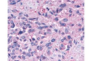 Anti-NPY4R / PPYR1 antibody IHC of human Brain, Glioblastoma. (NPY4R antibody  (Extracellular Domain))
